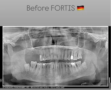 Fortis case
