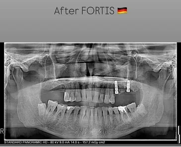 Fortis case